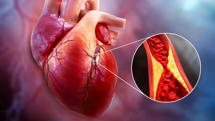 Alles wat jy moet weet van hoë cholesterol, hartsiektes en die nuutste behandeling